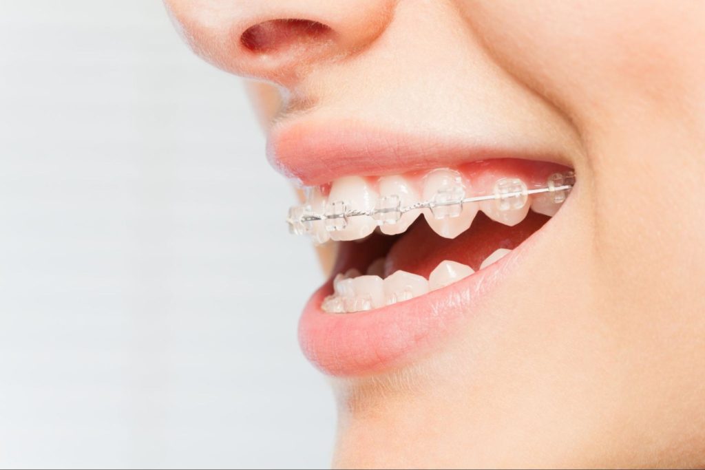5 Reasons to Get Adult Braces